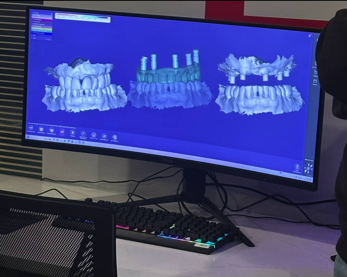 Aesthetic Dental Offers All-on-X full arch dental implants procedure at Aesthetic Dental in North Bergen