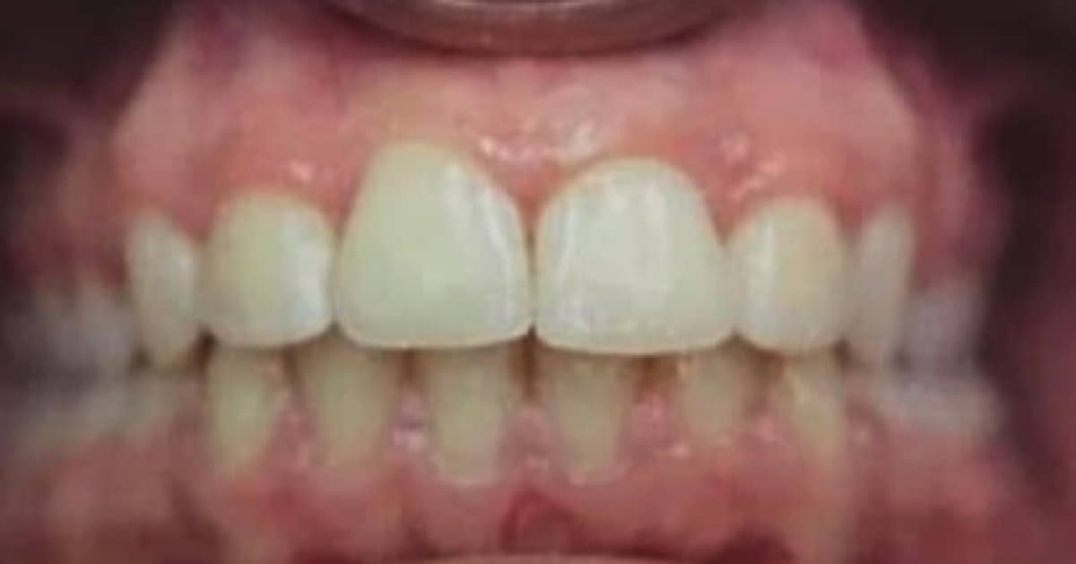 After Invisalign