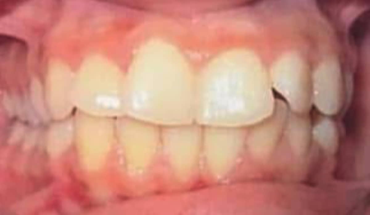 Before Invisalign