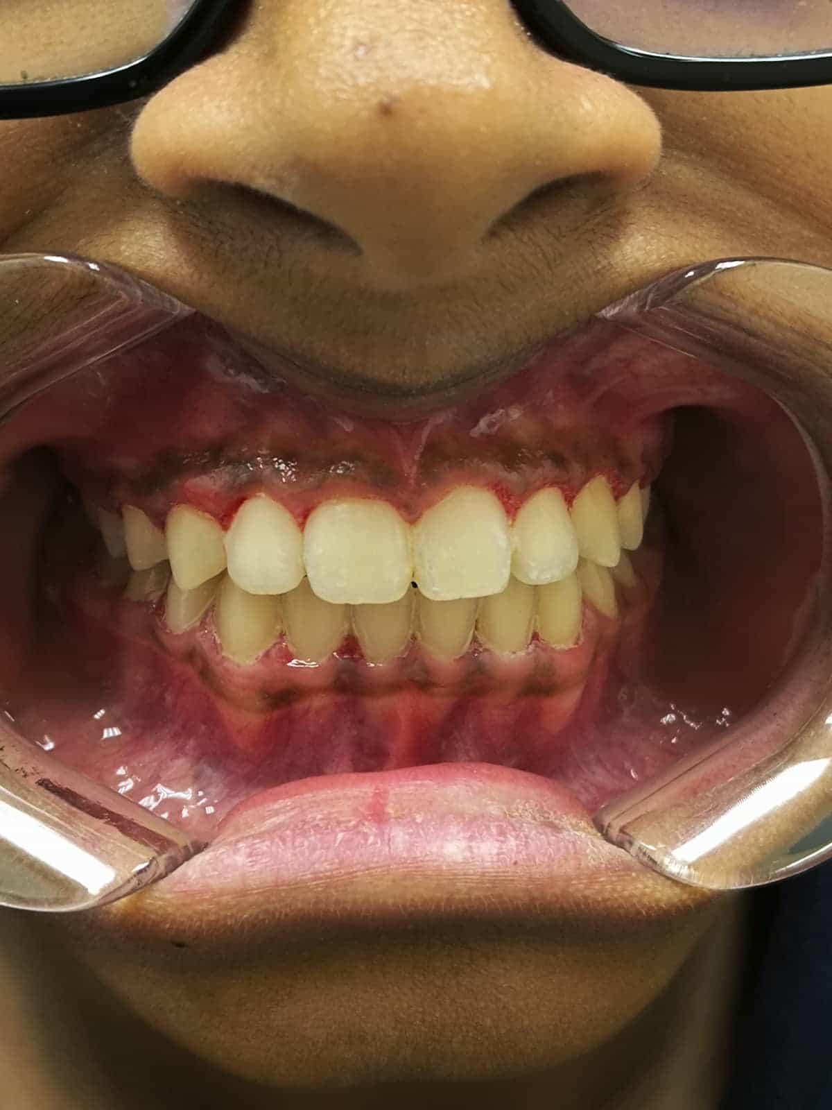 Before and after metal braces results for improving dental alignment