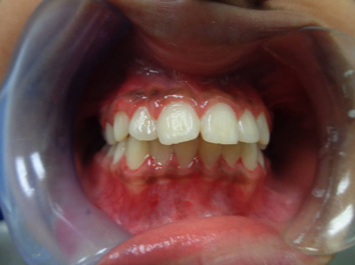 Before and after metal braces results for improving dental alignment