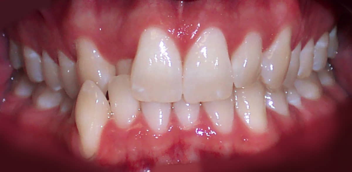 Invisalign clear aligners before and after results for teeth straightening