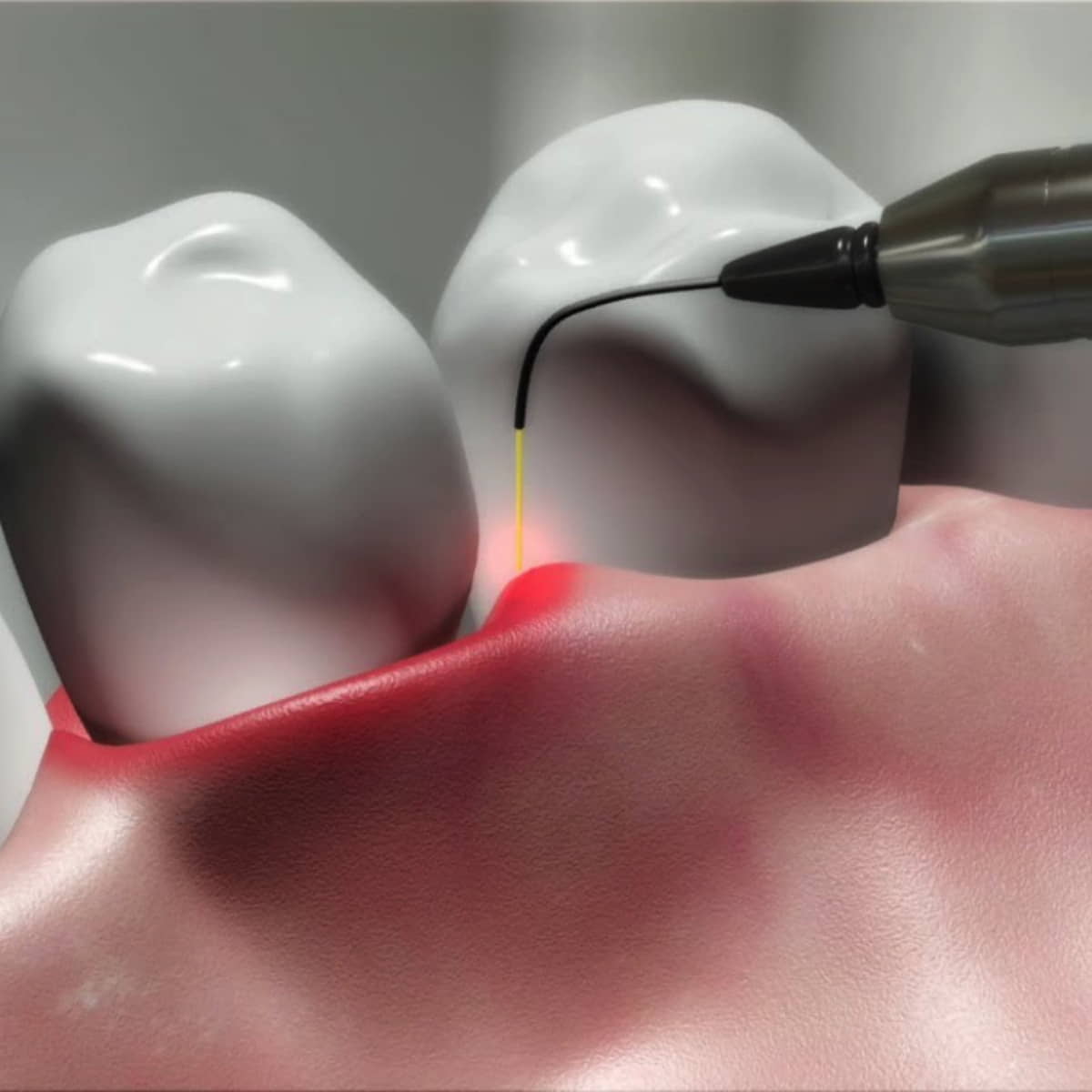 Dental implant procedure