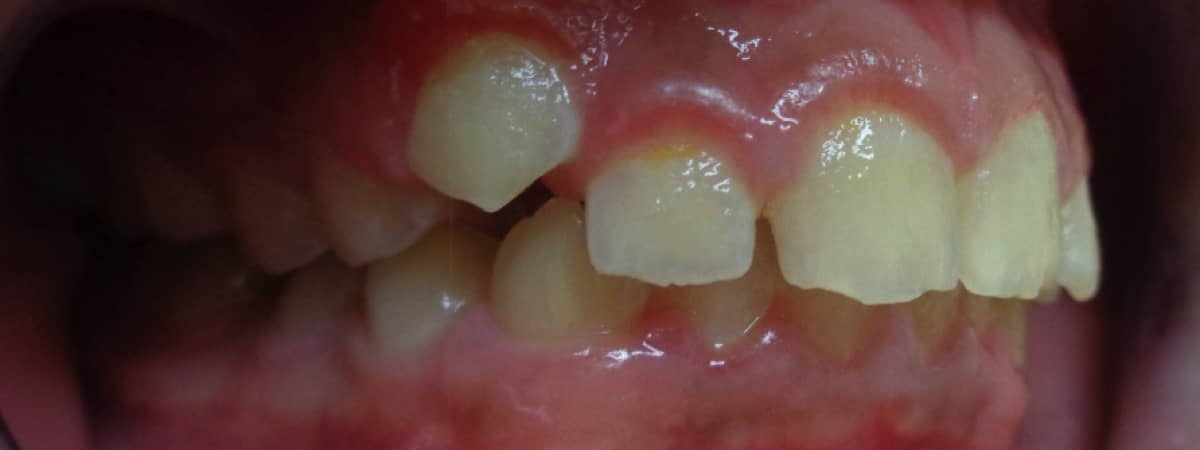 Metal Braces- Before and After