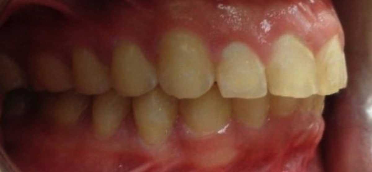 Metal Braces- Before and After