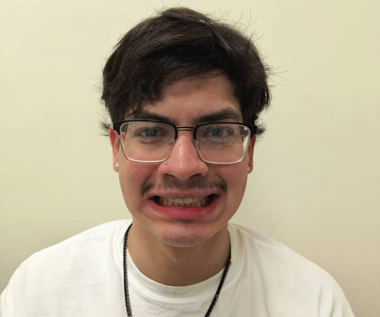 Orthognathic surgery with braces for facial symmetry after