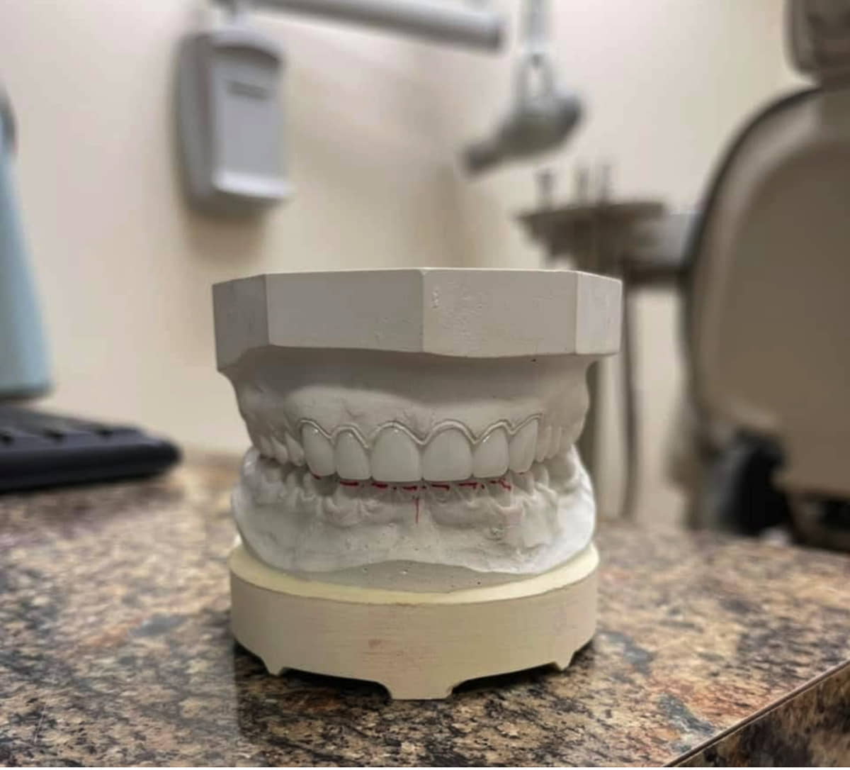 Veneers near me in North Bergen-resized