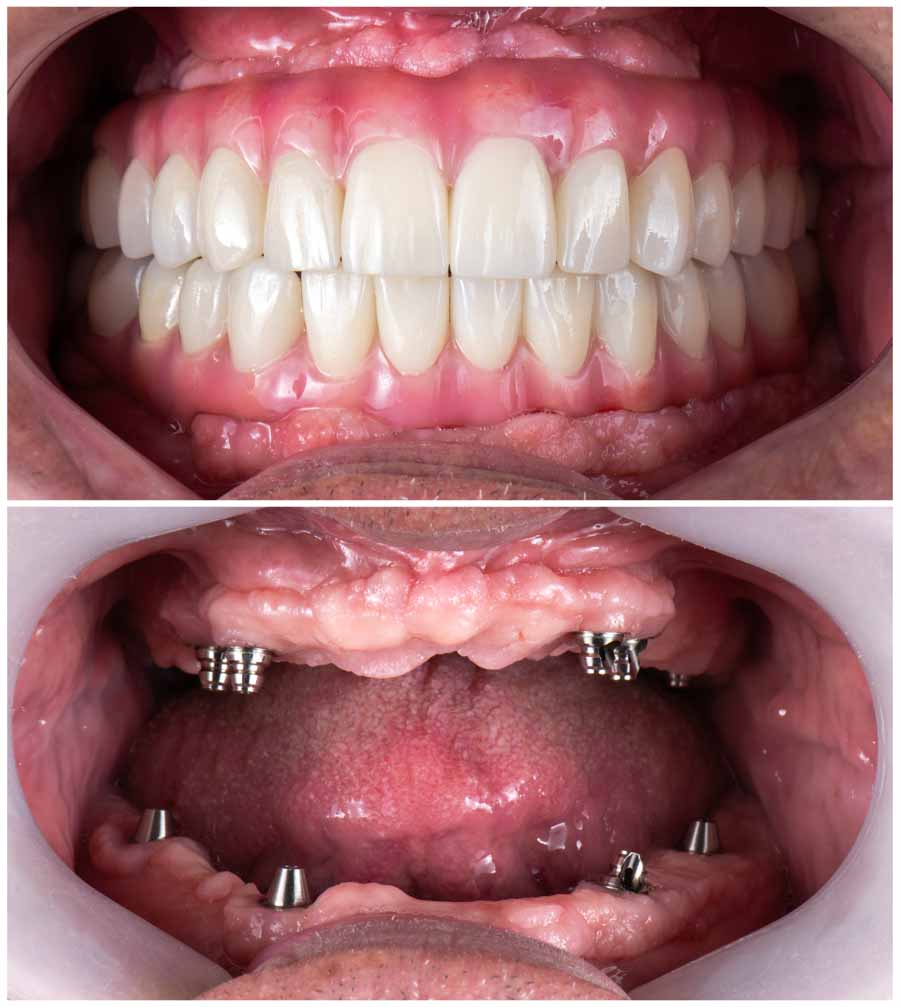 All-on-X dental implants at Aesthetic Dental in North Bergen, NJ