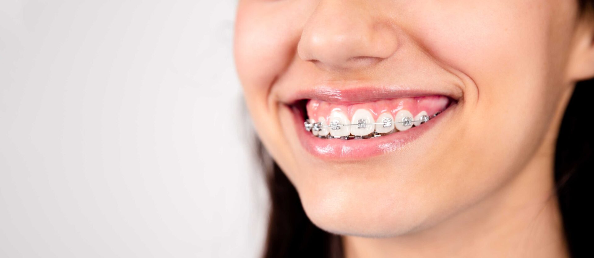 Patient smiling with traditional metal braces