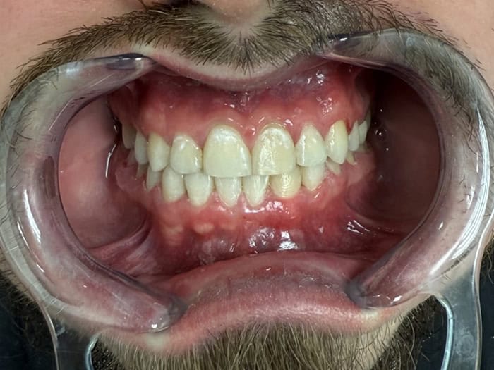 Breen after orthodontic treatment