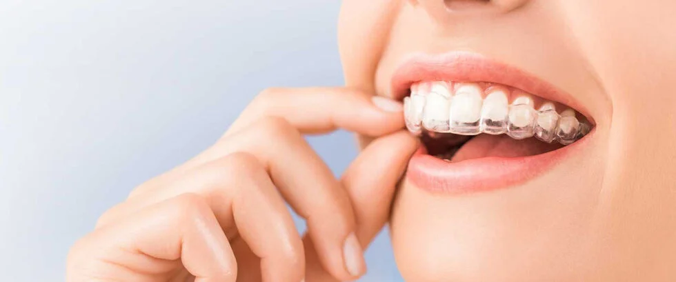 Invisalign Clear Aligners