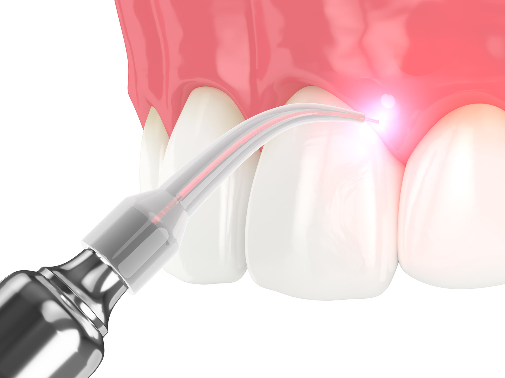 Dental implant procedure
