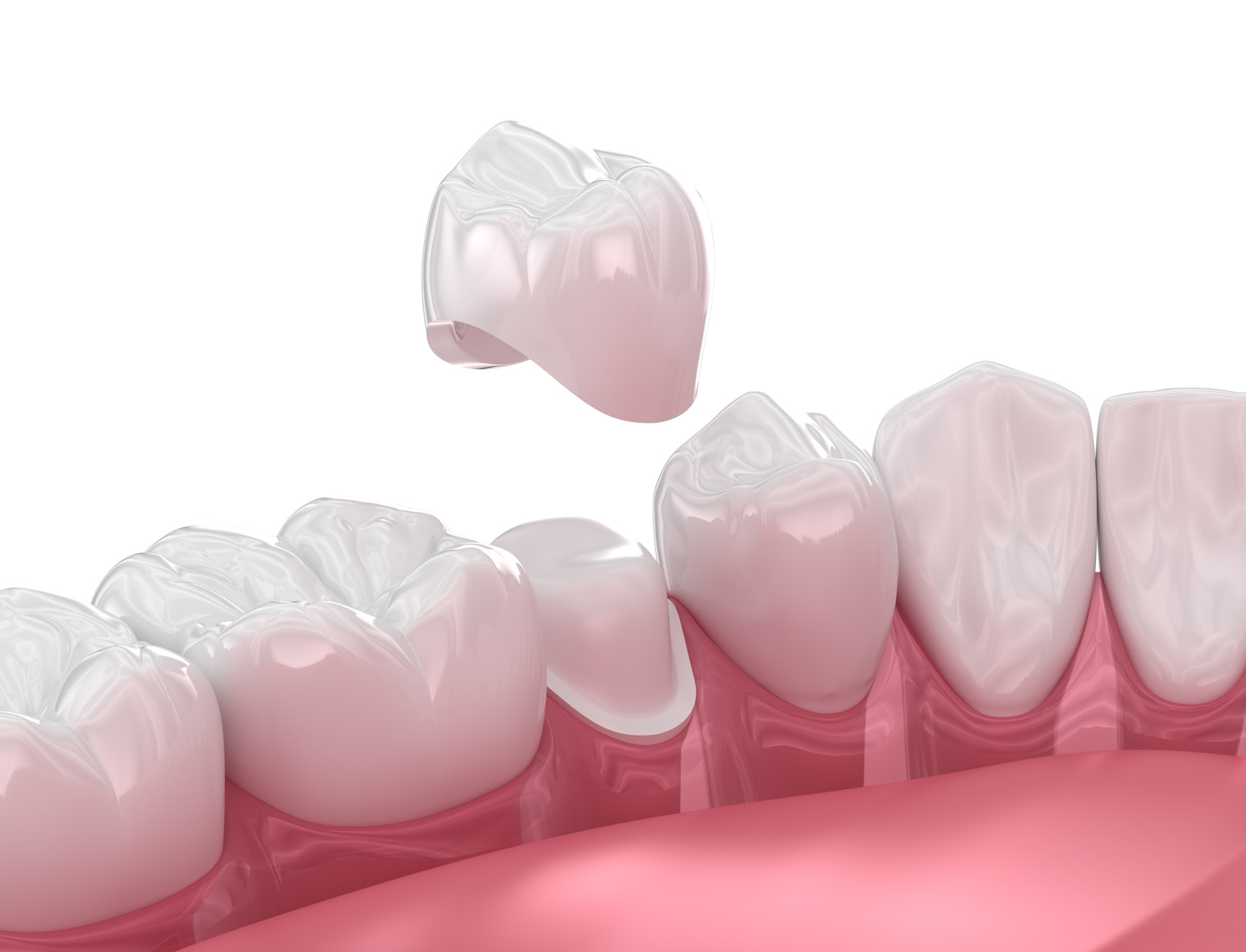 Porcelain dental crown restoration illustration