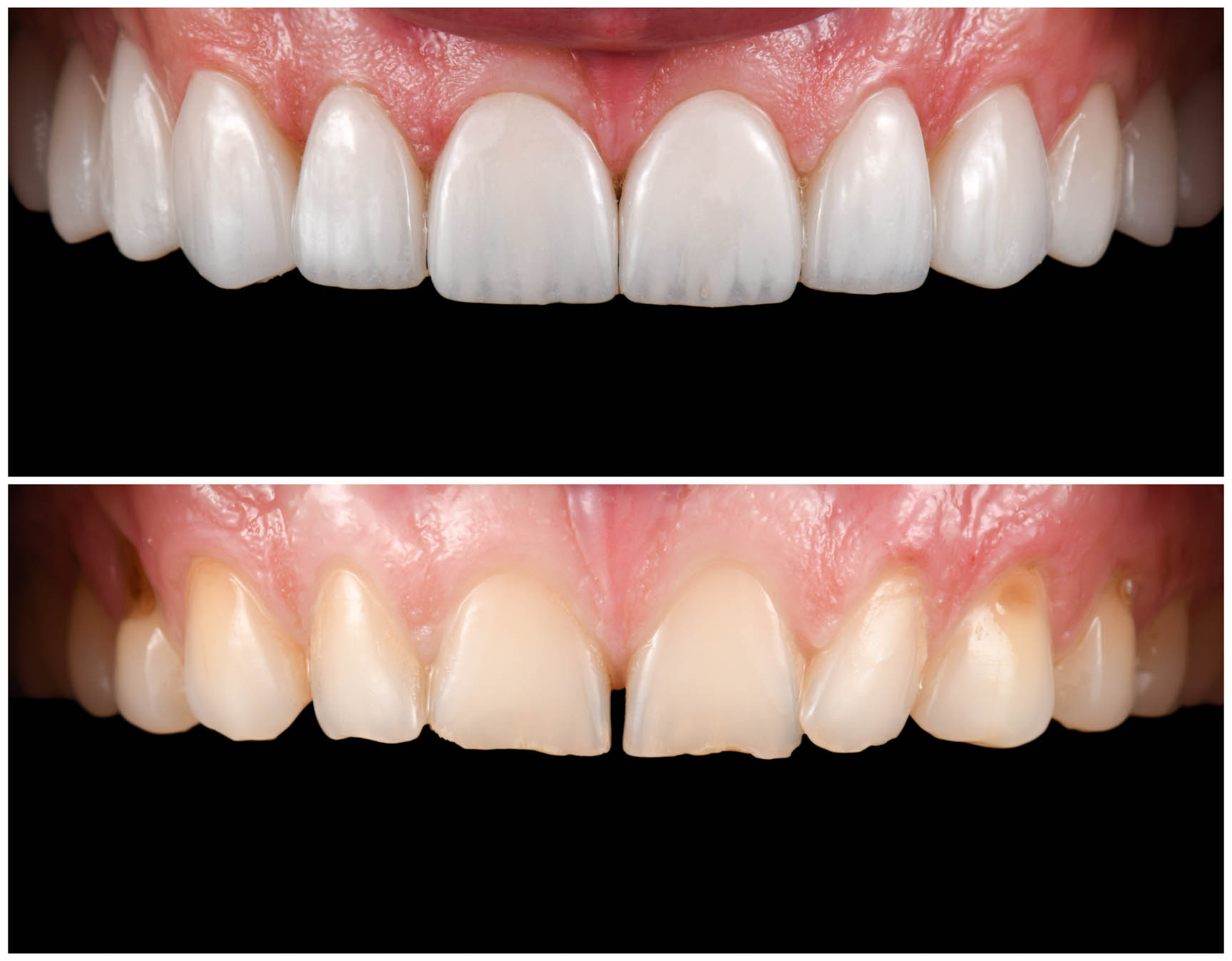 Before and after result of dental veneers