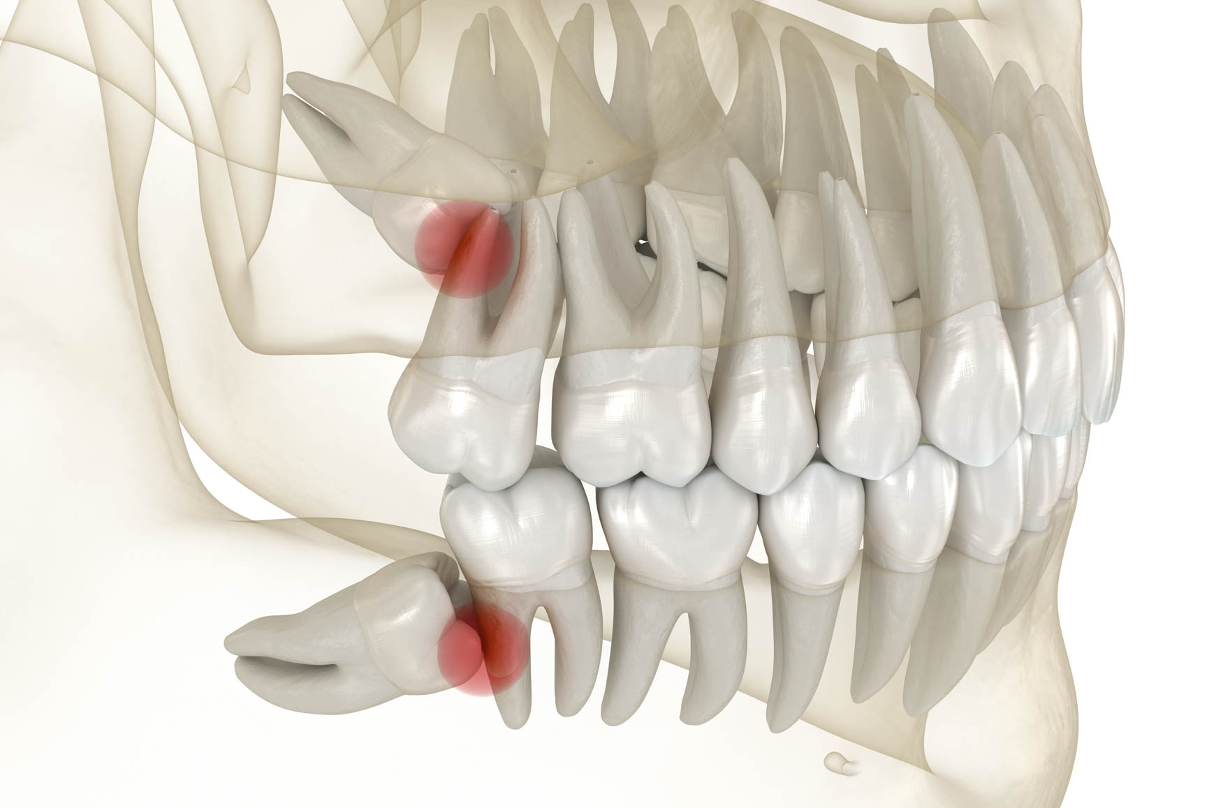 Wisdom tooth position illustration