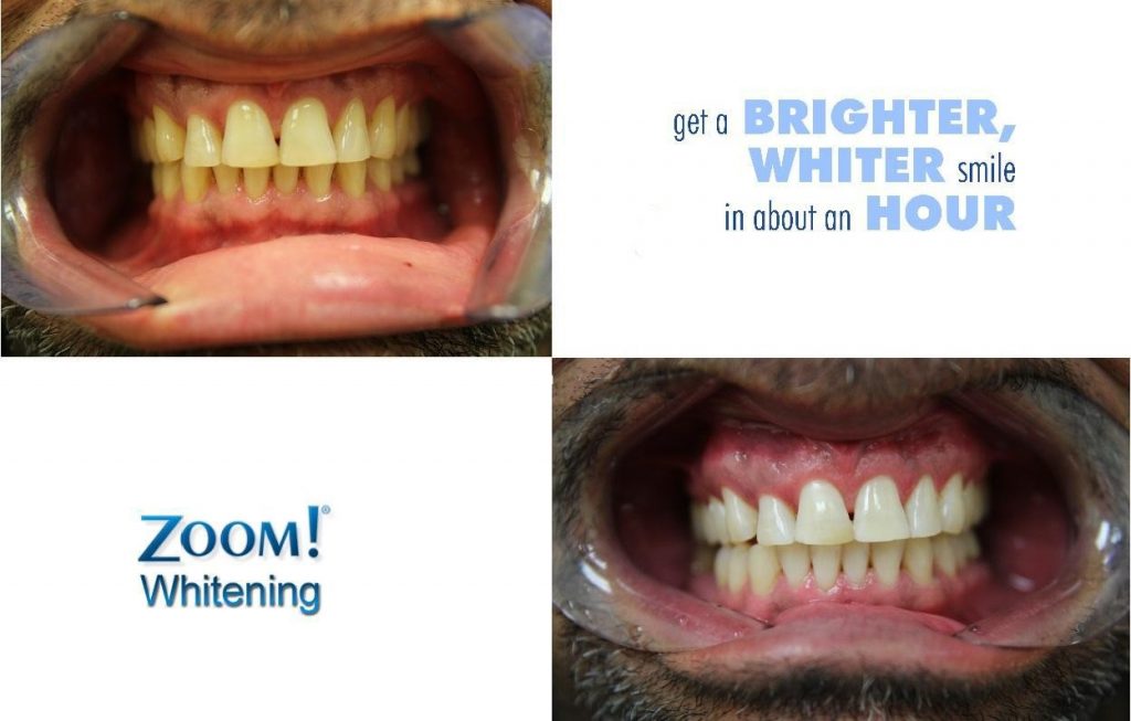 Zoom Whitening | Aesthetic Dental
